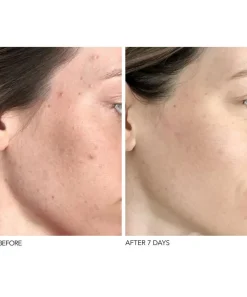 Dr. Dennis Gross Skincare Skin Concern|Masks & Exfoliators^Alpha Beta Universal Daily Peel 5 Pack